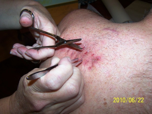 Melanoma-stitches_removal.jpg