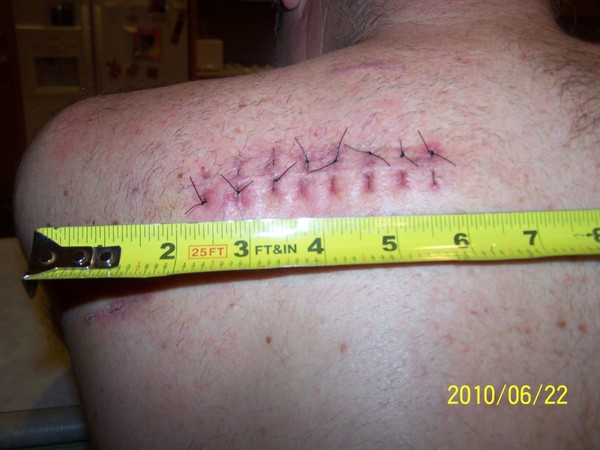 Melanoma-stitches_scale.jpg